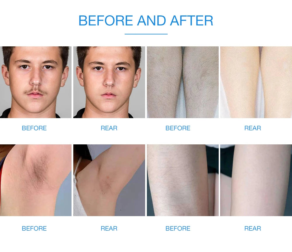 Laser Hair Removal