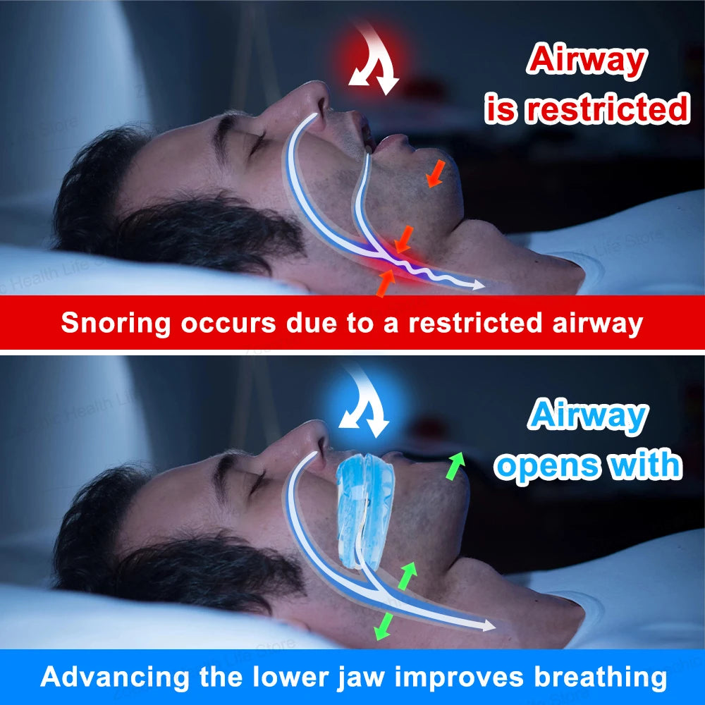 Adjustable Anti Snoring Mouth Guard